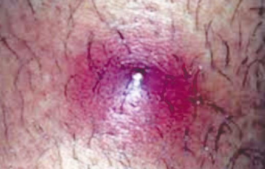 bump on pubic area red swollen hard movable causes get rid