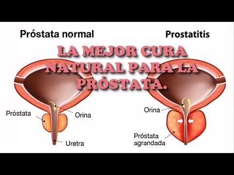 El platano es bueno para la prostata