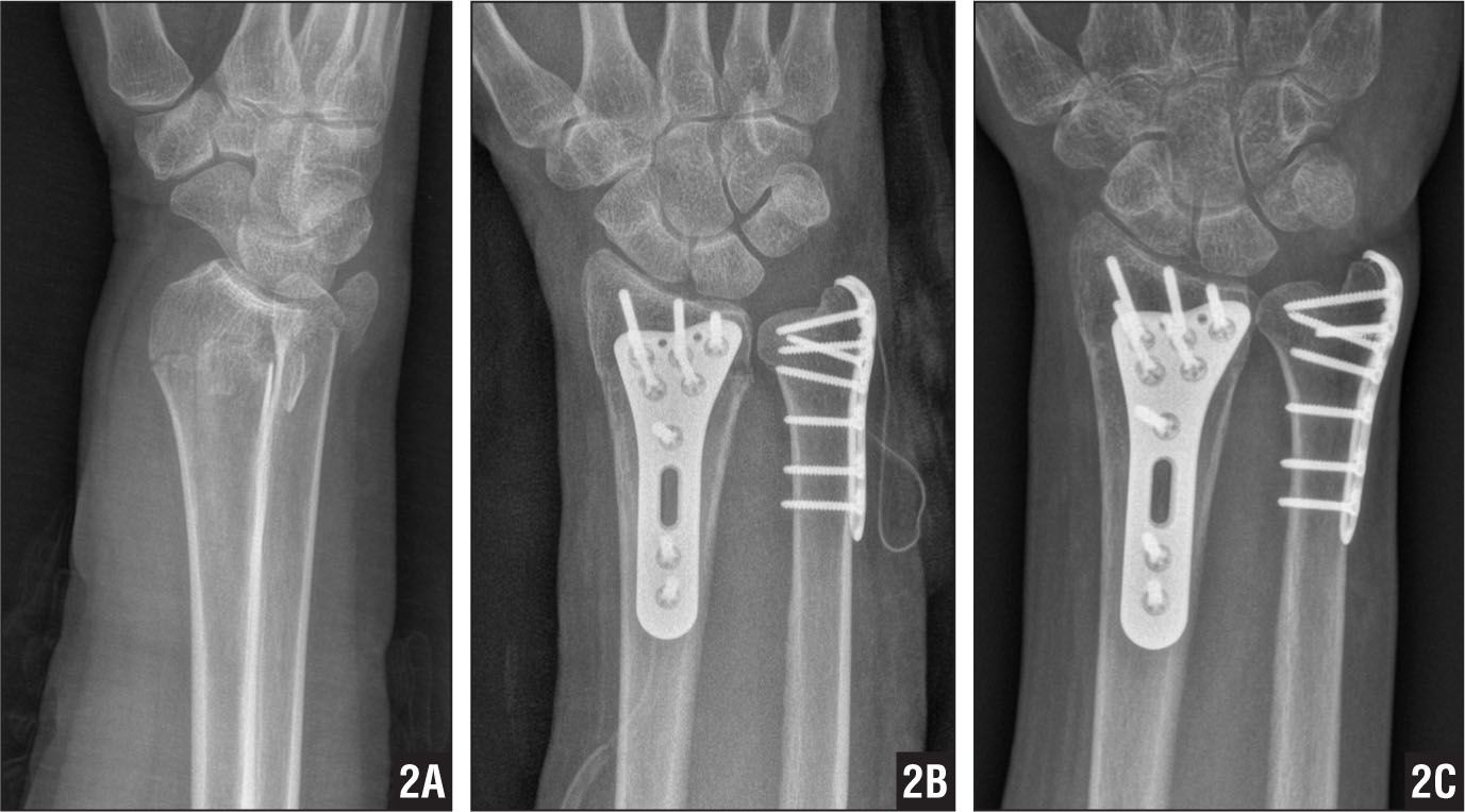 Distal ulna hook plate | Ulna fracture, Orthopedics, Fracture