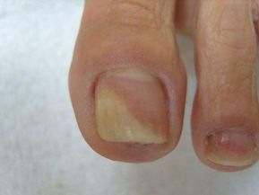 A Micose nas unhas é uma doença comum que atinge 10% da população adulta e 20% dos idosos. Os fungos que provocam a micose geralmente são adquiridos devido o ambiente quente e úmido. Caso não seja tratado a pessoa corre o risco de perder unha. Se você sofre deste problema, não se preocupe! Existe uma … Gel Uv Nails, Toe Nails, Mani Pedi, Pedicure, Autumn Kitchen Decor, Oval Nails, Nail Treatment, Wedding Nails, Pin Up Girls