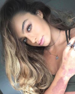 Sommer ray birthmark Sommer ray birthmark