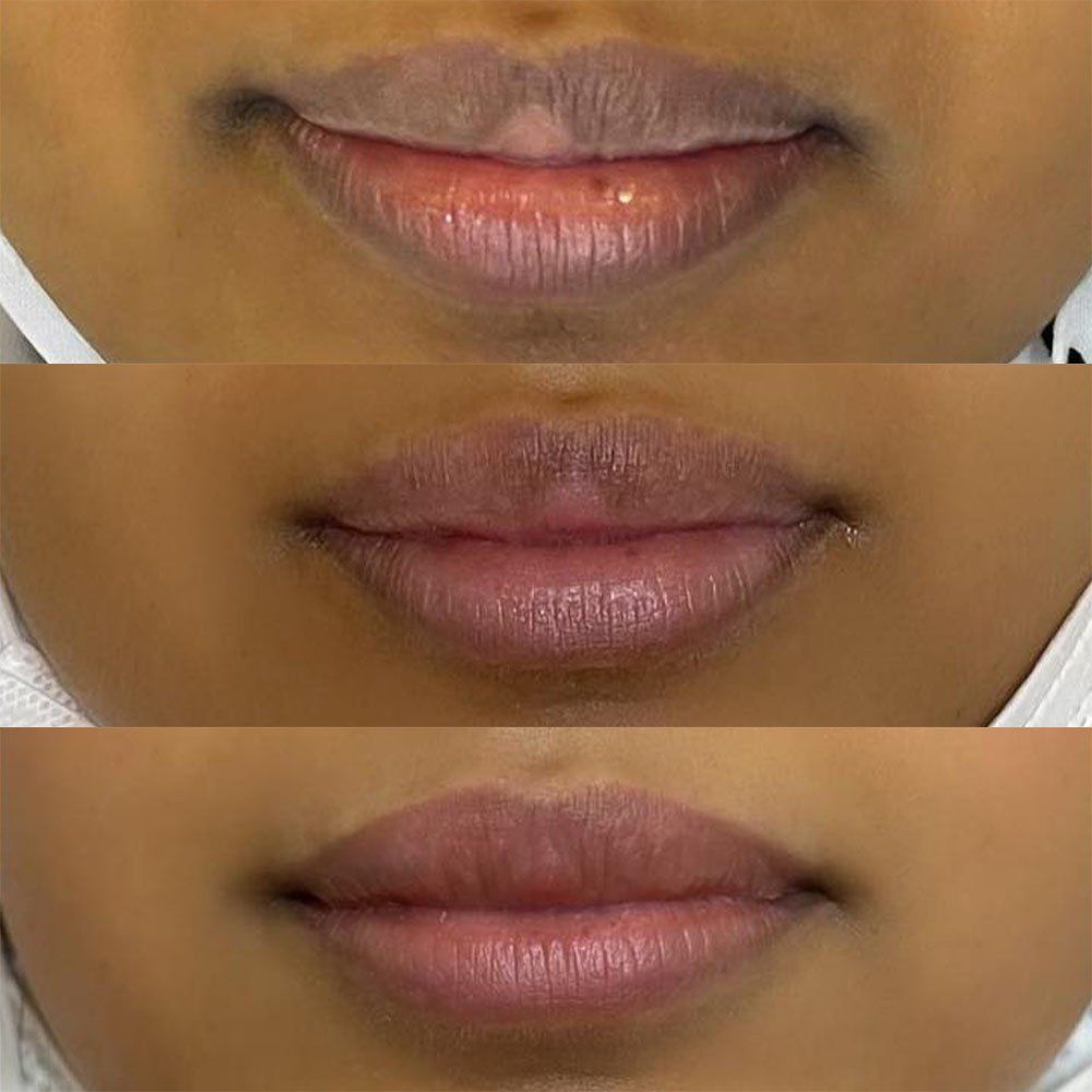Laser Lip Lightening Effects Cost Risks Lip Lightening Lip laser-lip-lightening-effects-cost-risks-lip-lightening-lip