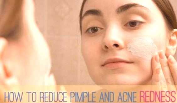 #swelling #redness #reduce #pimple #size #how #and #to How to Reduce Pimple Redness, Swelling and Size?You can find Reduce pimple redness and more on our website.How to Reduce Pimple Redness, Swelling and Size? Reduce Pimple Redness, Acne Redness, How To Reduce Pimples, Head Pimples, Skin Care Pimples, Acne And Pimples, Diy Acne Treatment, Skin Treatments