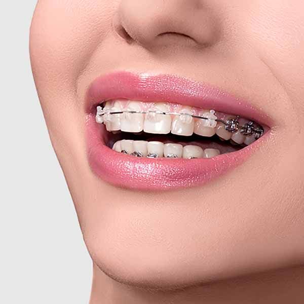 Implant Fiyatlari Dis Arac Implant Fiyatlari Dis Arac