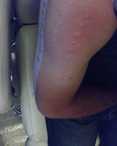 Dust Mites Dust Mites Mites Dust