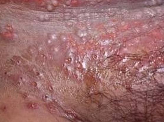 Natural Permanent Cure For Herpes Natural Permanent Cure For Herpes