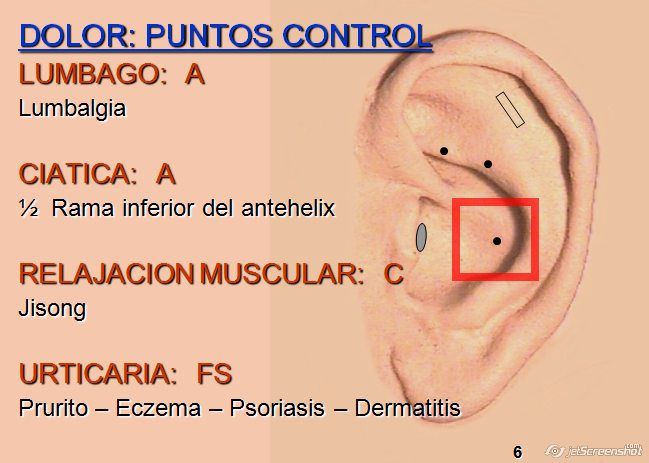 Acupuntura Para Adelgazar Mitos Y Realidades De Los Efectos Agujas Para Bajar De Peso Consecuencias