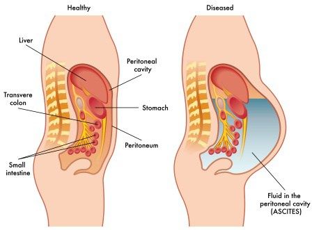 Abdominal And Distention While Detoxing From ascites drinks ayurvedic treatment Abdominal And Distention While Detoxing From ascites drinks ayurvedic treatment