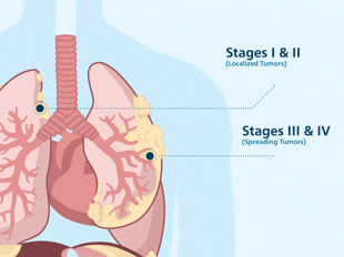 Mesothelioma: symptoms causes and treatments # ...