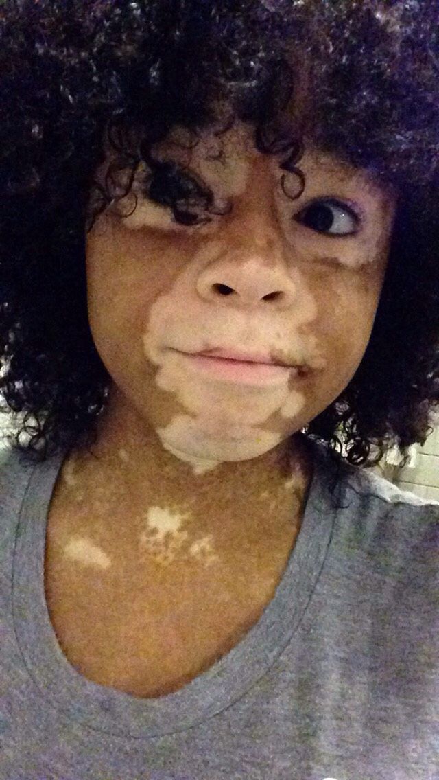 Am I cute or naw Vitiligo Vitiligo treatment Laser Am I cute or naw Vitiligo Vitiligo treatment Laser
