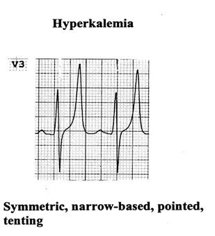 ecg signs of hyperkalemia ecg signs of hyperkalemia
