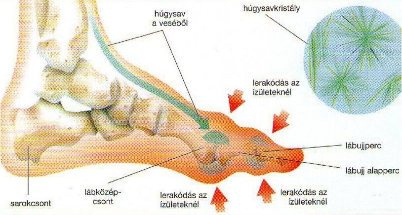 Ízületi gyulladás - A legfontosabb tudnivalók