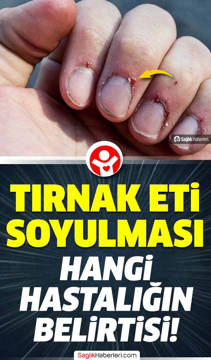 Tirnak Eti Soyulmasi Hangi Vitamin Eksikligi Belirtisidir Saglik Haberleri 2021 Saglik Saglik Ve Fitness Saglik Ipuclari Tirnak Eti Soyulmasi Hangi Vitamin Eksikligi Belirtisidir Saglik Haberleri 2021 Saglik Saglik Ve Fitness Saglik Ipuclari
