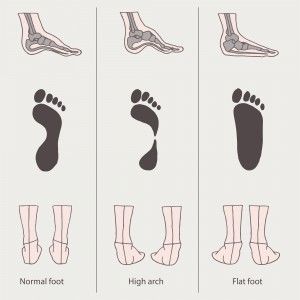 set of flat foot, and high arch, medical illustration Plantar Fasciitis Treatment, Does Running, Foot Anatomy, Fallen Arches, Foot Exercises, Podiatry, Foot Type, Foot Arches, Flat Feet