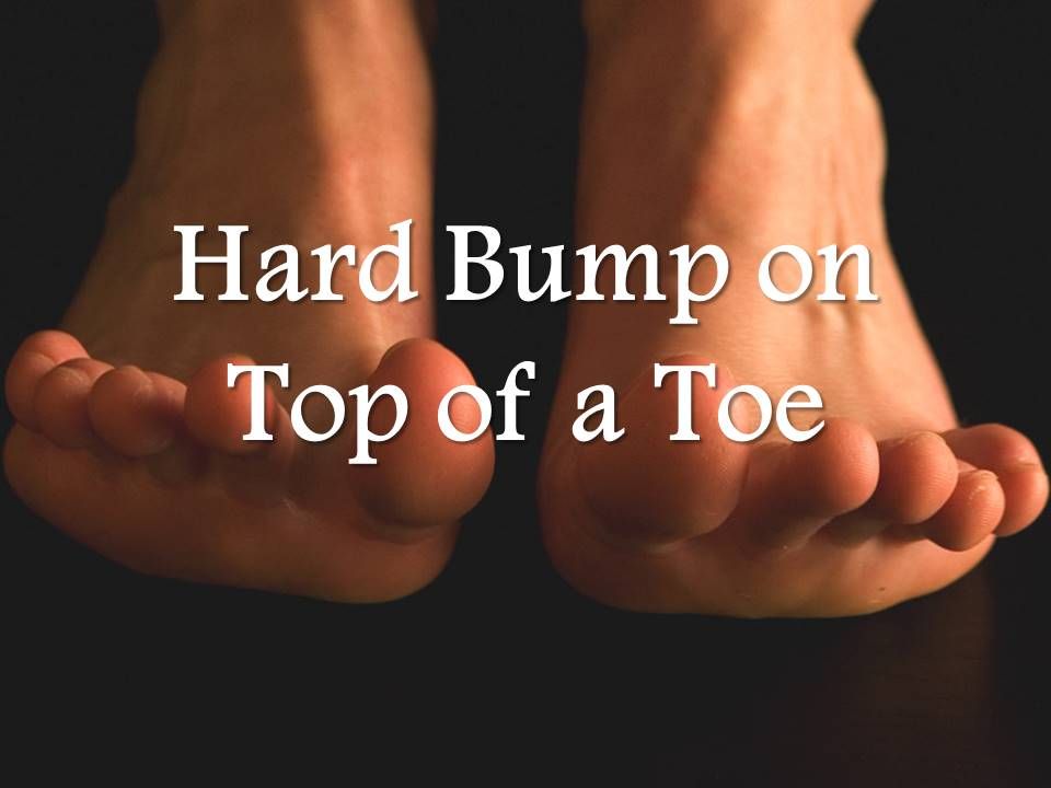 hard bump on top a toe toes bump big toe hard bump on top a toe toes bump big toe