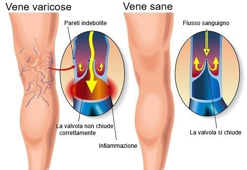varicele vene sânii